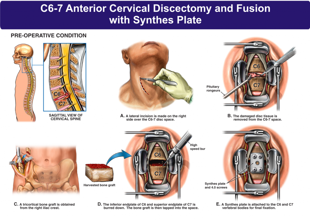 C6-7 Anterior Cervical Discectomy And Fusion With Synthes Plate - NBG ...