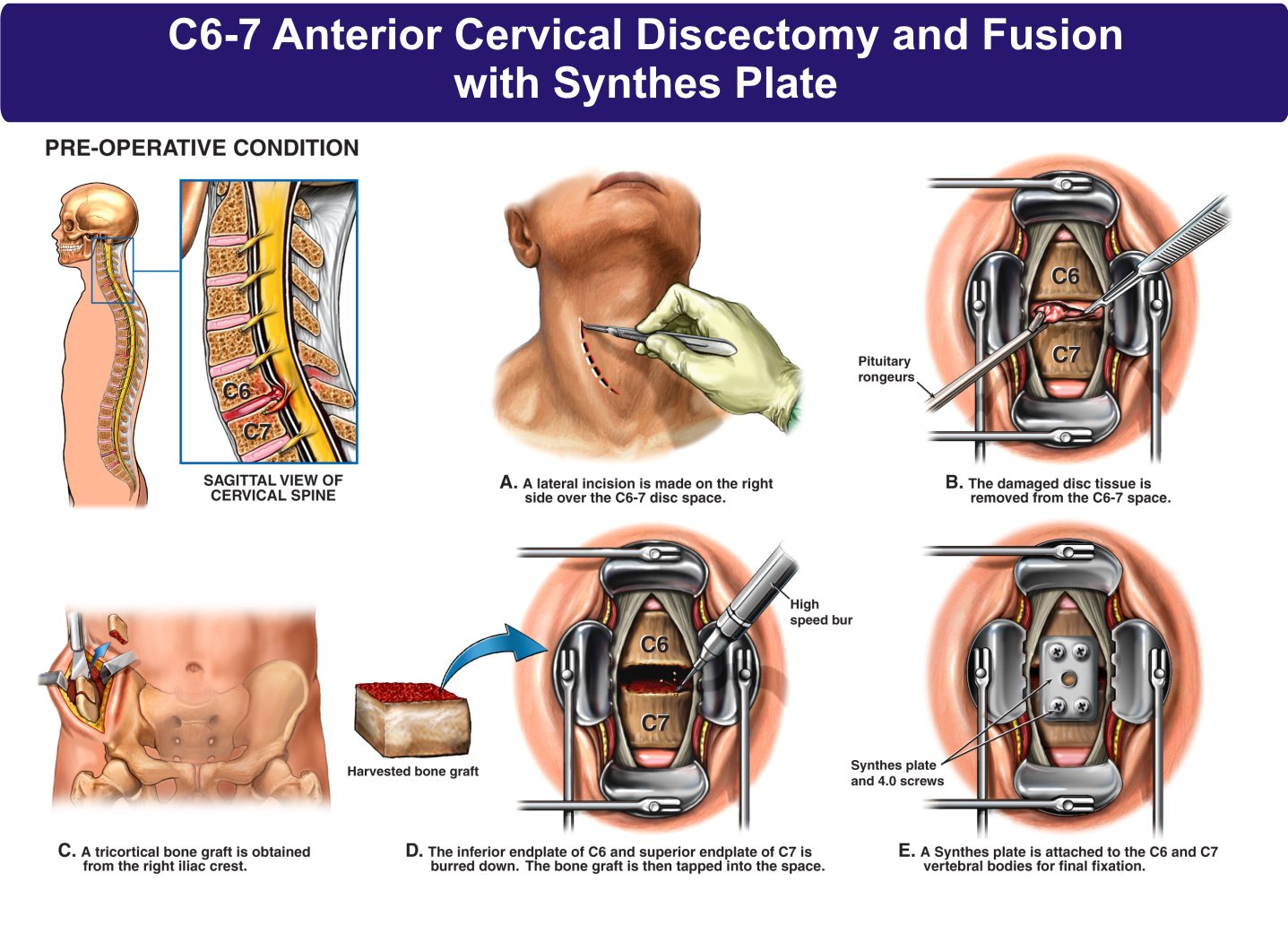 C67 Anterior Cervical Discectomy and Fusion with Synthes